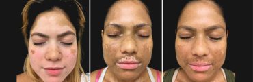 Treatment For Vitiligo || Treatment For White Patches on Skin
