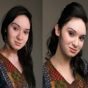 Vitiligo-Makeup-Before-and-After