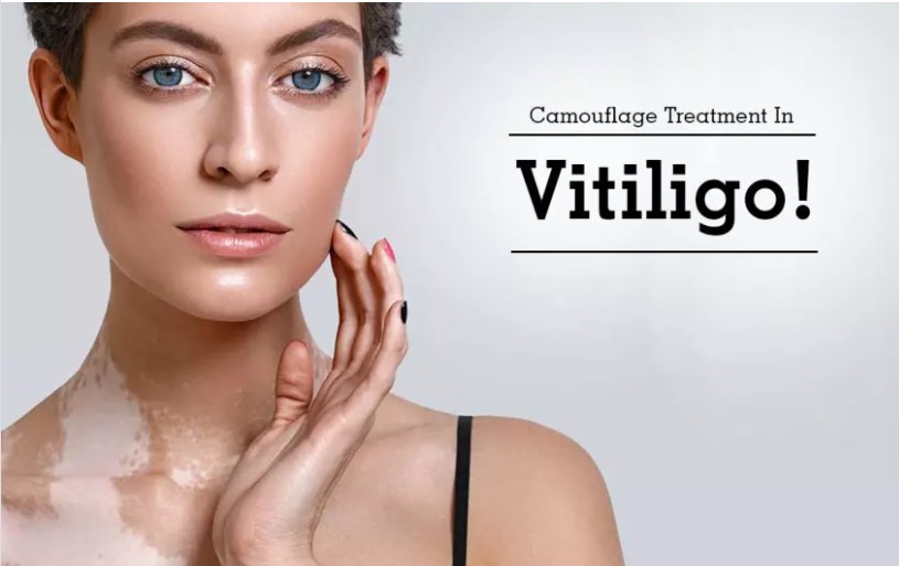 Camouflage Treatment In Vitiligo!