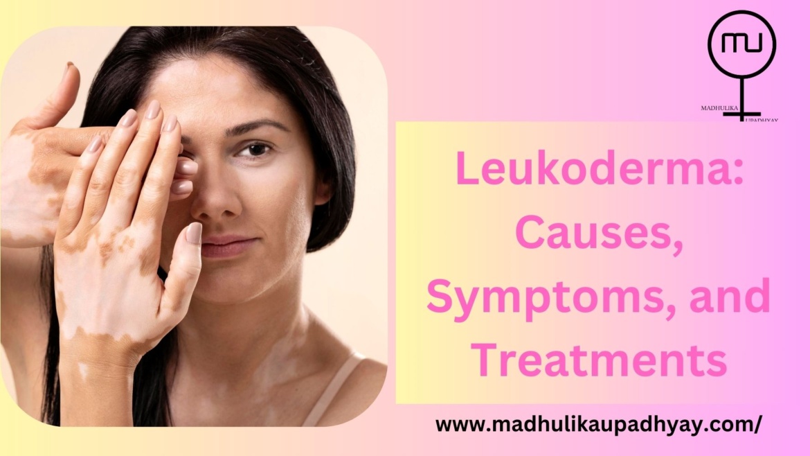 Understanding Leukoderma: Causes, Symptoms, and Treatments
